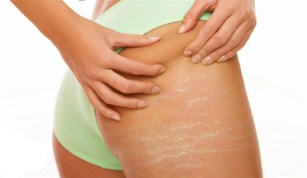 Dipomed Cilt Çatlağı Onarımı